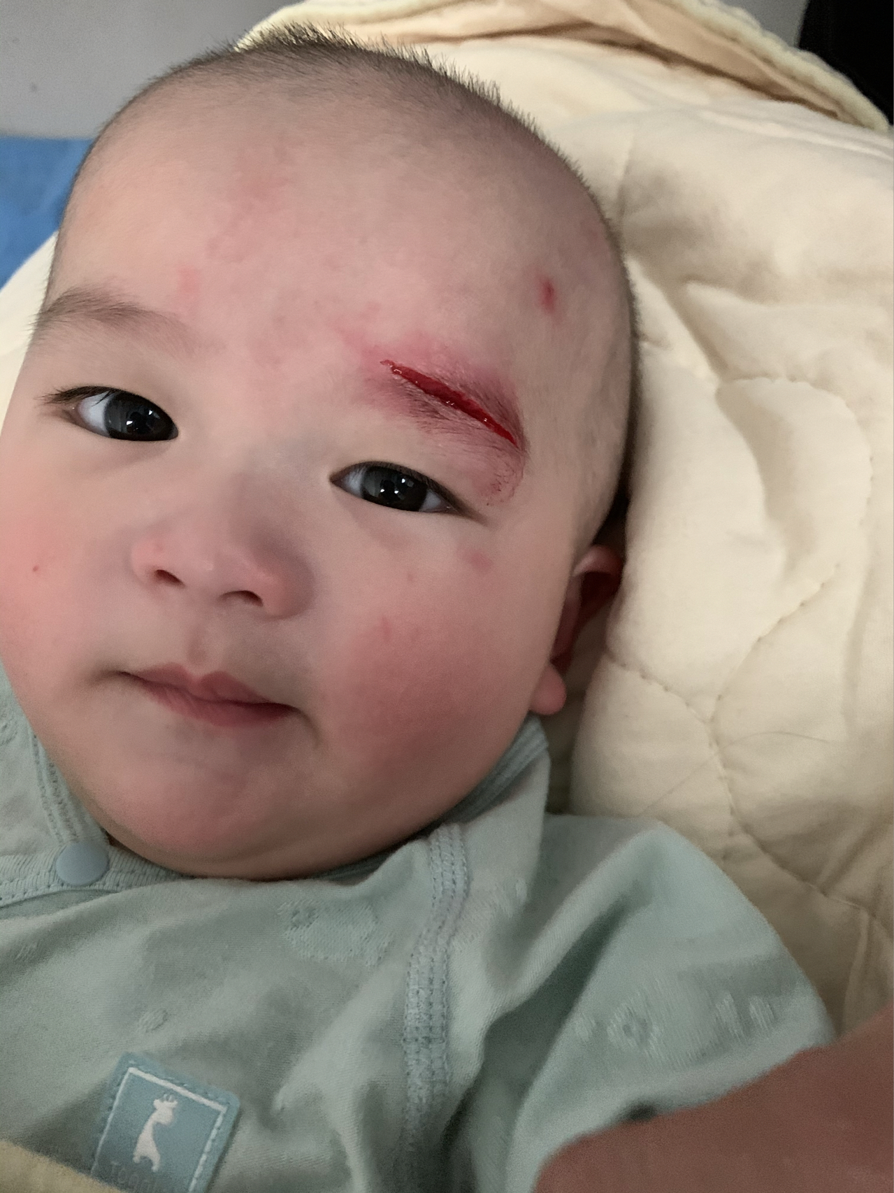 月嫂摔了宝宝如果月嫂在照顾宝宝的过程中不慎导致宝宝摔倒，这是一种非常严重的情况，需要立即采取行动。以下是一些建议